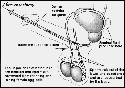 Vasectomy N.B. - Serving Fredericton, Saint John, & Moncton