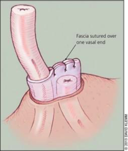 Non-Scalpel Vasectomy - The Doctors Werribee